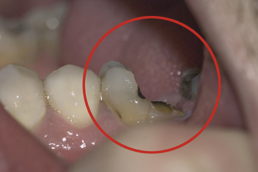 broken tooth - abscess